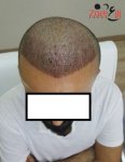 3 ايام بعد زراعة الشعر في تركيا للرجال - Zare3 (1).jpg
